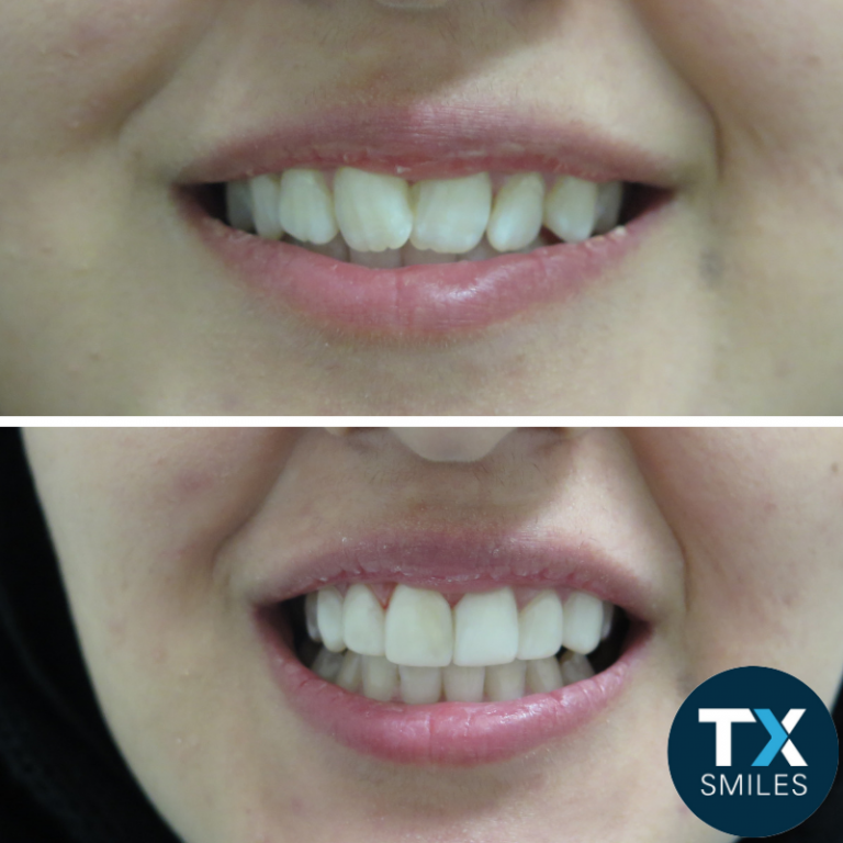 Tx Smiles No Prep Veneers Before After 0003 768x768