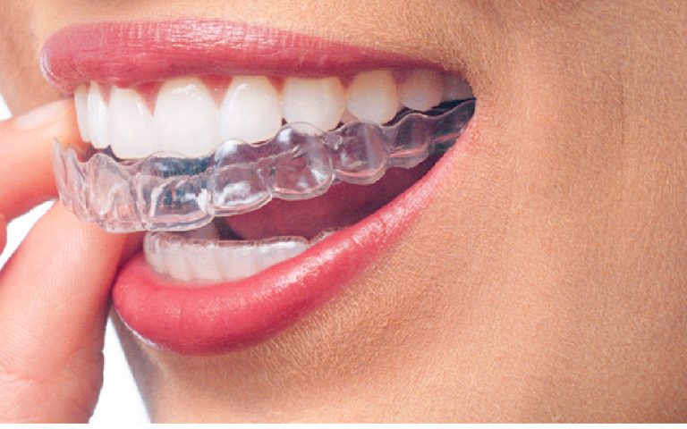 Invisalign 09 1 768x480