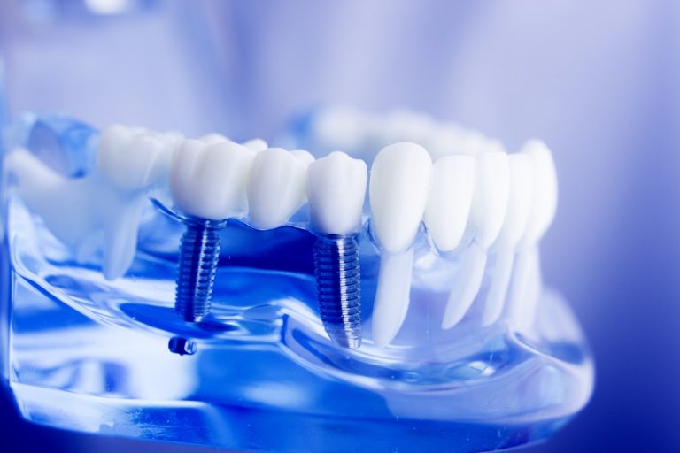 dental implant 768x512