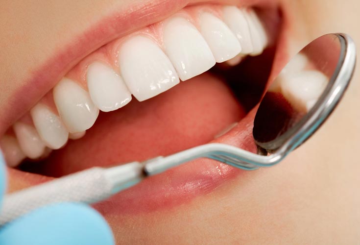teeth whitening