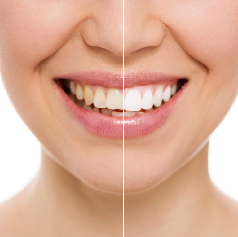 Teeth Whitening Brisbane 768x765