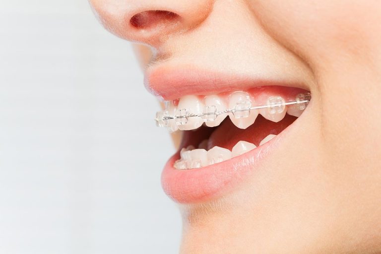 ceramic braces 768x512