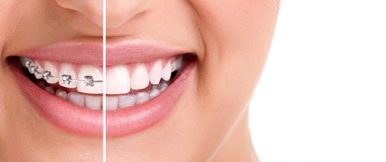 Moreland Dental Orthodontics 768x323