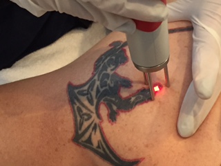 laser tattoo removal
