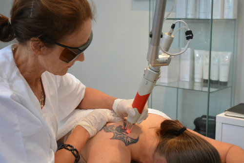 sydney tattoo removal