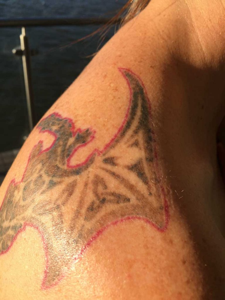 tattoo removal results 768x1024
