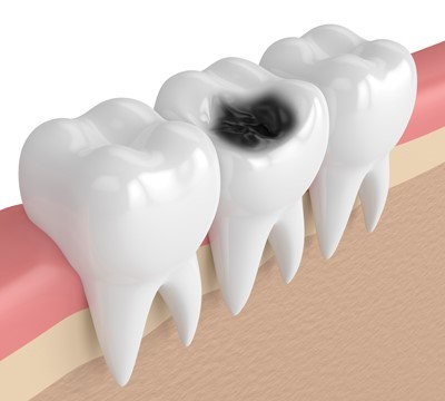 toothdecay
