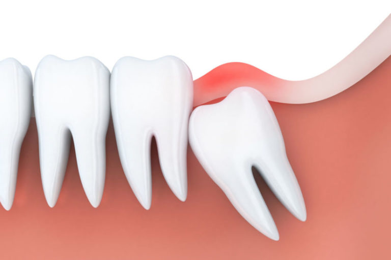 wisdom tooth 768x512