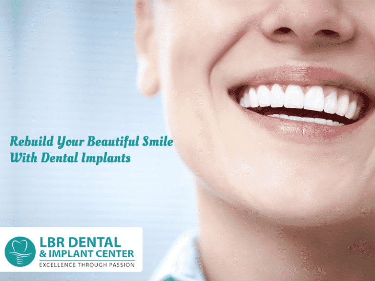 Rebuild Your Beautiful Smile With Dental Implants 768x576