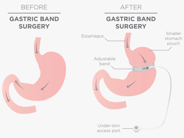 SGC gut2 Gastric Band 2 768x576