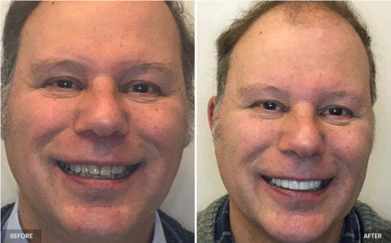before after 768x477