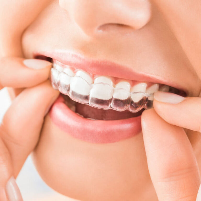 Invisible Braces 768x768