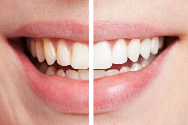 Dental Veneers Cost 768x512