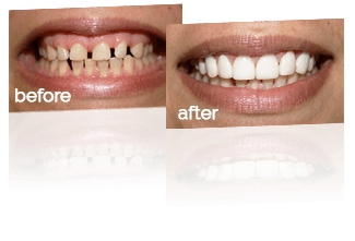 before after reflect