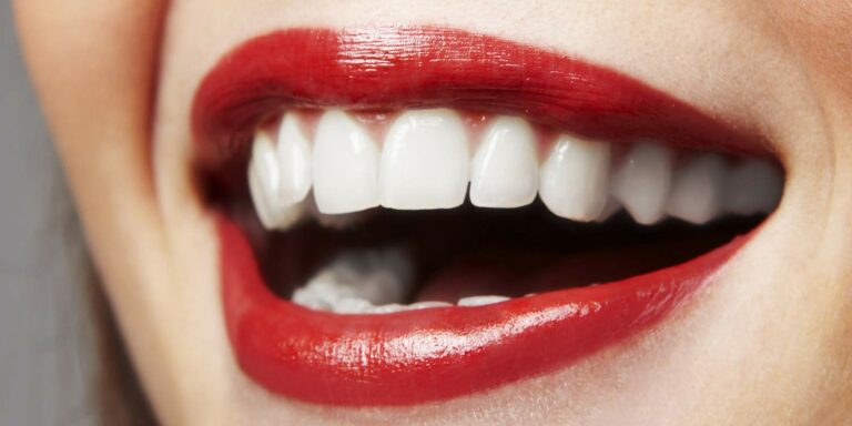 porcelain veneers 1 768x384