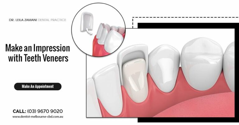 teeth veneer 768x403