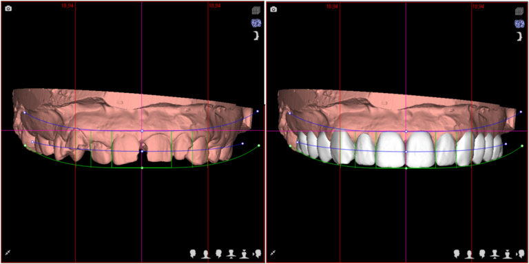 digital smile design before after burwood dental care 768x383