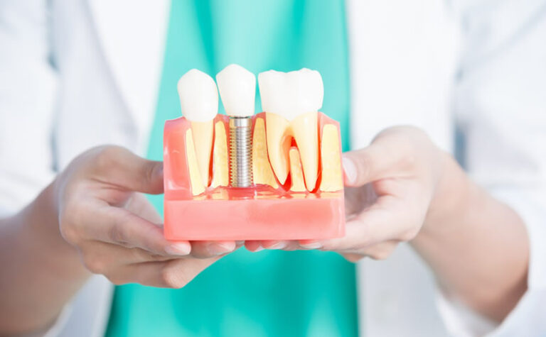 implants covered by insurance 768x475