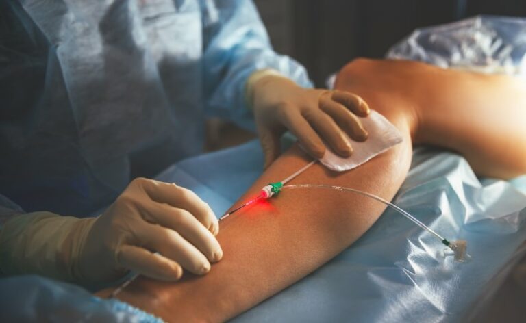 laser varicose veins 2 768x472