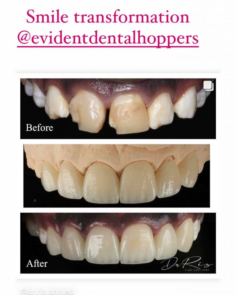 HCFD Smile transformation 768x960