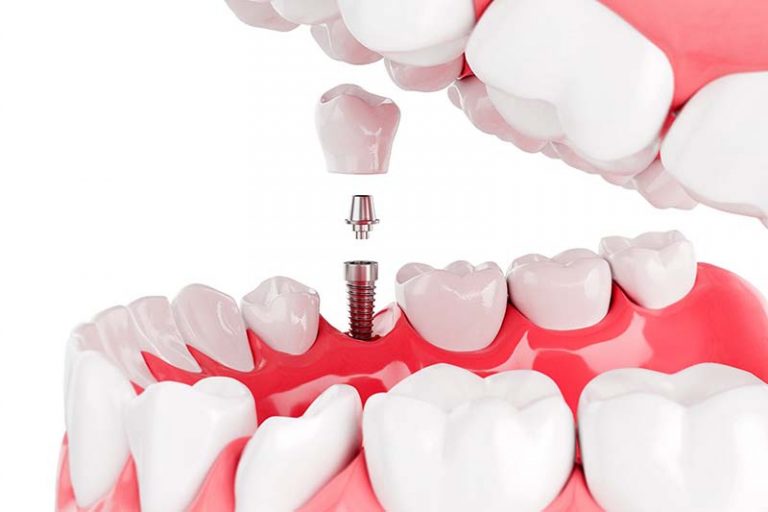 dentist annerley 6 768x512
