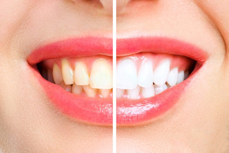 Teeth Whitening 768x512