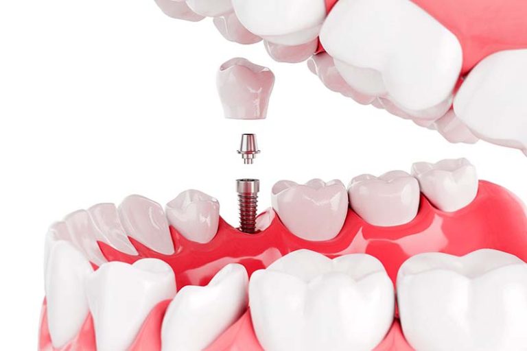 dentist annerley 6 768x512