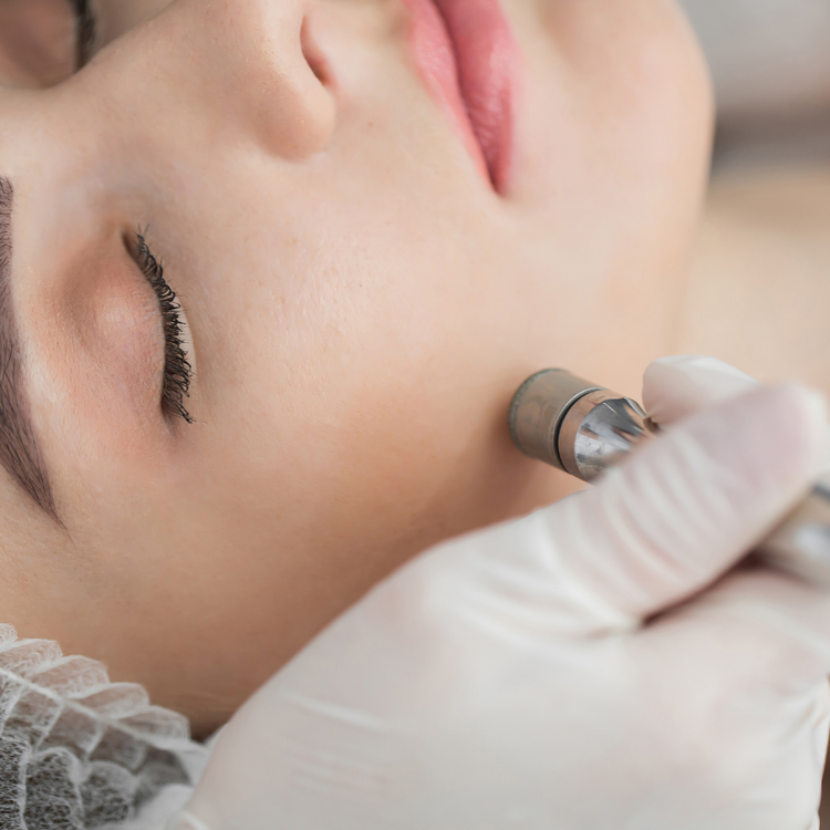 Microdermabrasion Microdermabrasion